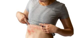 CPD Managing Shingles