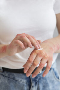 Psoriatic arthritis: will disease prevention trials soon become possible?