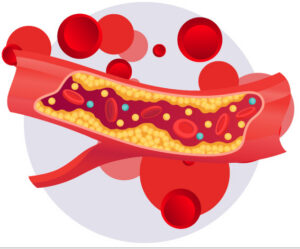CPD: Management of Dyslipidaemia (Part 1)